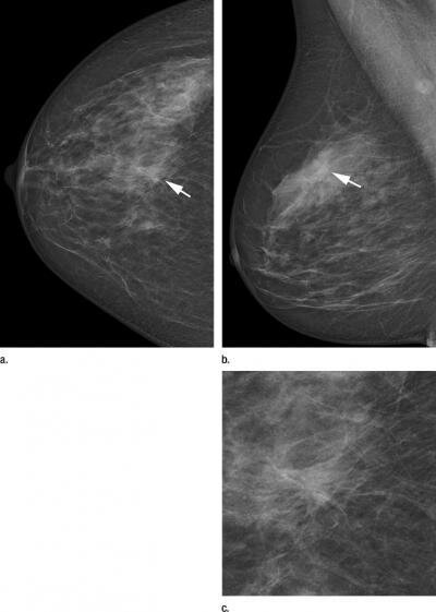  Two -view -Screening -Mammographien mit dem DR - Photonen- Zählsystem erhalten