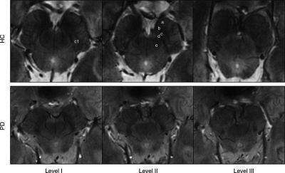  Substantia Nigra Scans