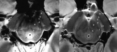  Substantia Nigra Scans