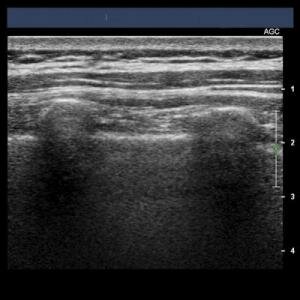  Lungen Ultraschall
