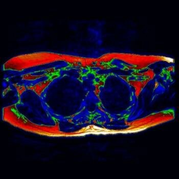  Brown Fett MRI
