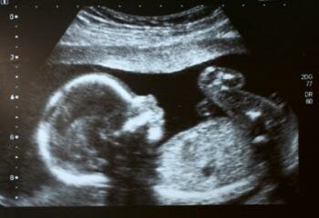  Scannen des Babys im Mutterleib