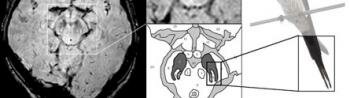  Tell- tail Bild MRI Diagnose der Parkinson-Krankheit