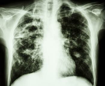  X-Ray des Lungenfibrose