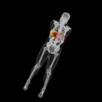  Simulierten 3D- Dosismessungen der Brust ( 2 von 2)