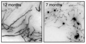  Wirkung der Alzheimer-Krankheit auf cholinergen Neuronen