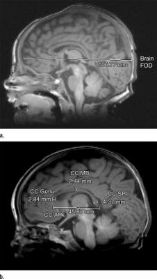  Gehirn Fronto - Occipital Entfernung