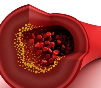  Cholesterin-Plakette in Arterie