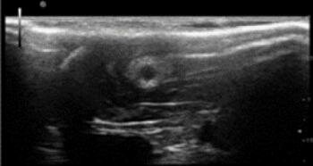  Chitosan Nerve Conduit