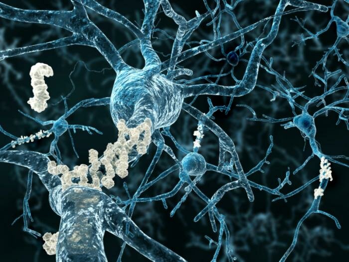  alzheimers Amyloid-Plaques