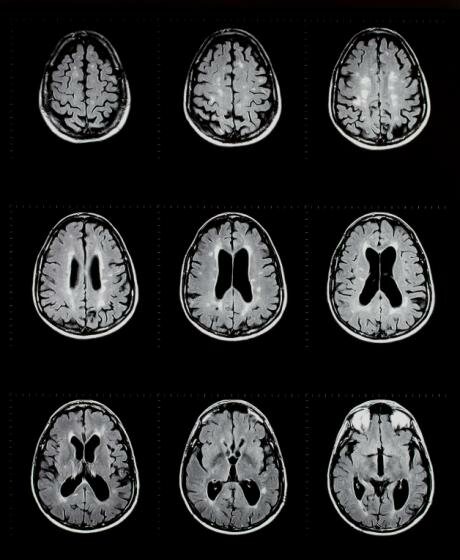 MS Gehirn-Scans