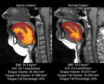  Tongue Fett bei Patienten mit obstruktiver Schlafapnoe