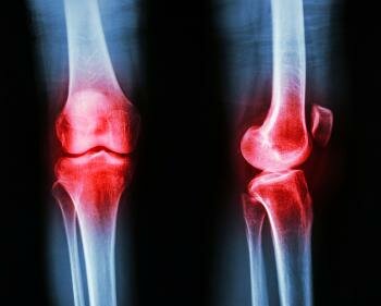  Xray zeigen Osteoarthritis des Knies