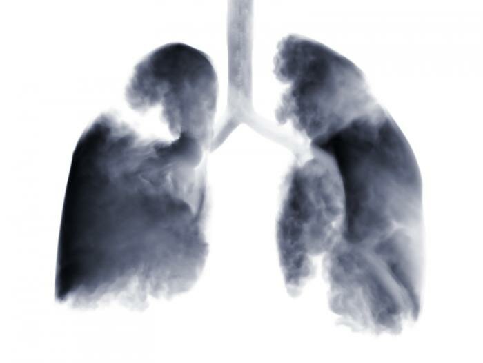  X -ray von Lungenkrebs ]