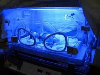  [ UV - aktivierten Membran löst sanft Medikamentendosis auf der Haut eines Frühchen ]