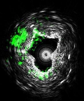  [ Dieses Bild ist mit einer neuen Art von medizinischen Imaging-Technologie , die Herz-Kreislauf -Krankheit zu diagnostizieren könnten getroffen ]
